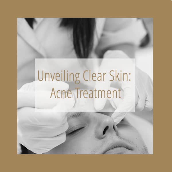 Unveiling Clear Skin: Acne Treatment